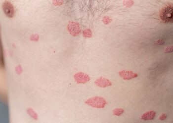 Lichen sclerosus: priežastys, simptomai, diagnostika ir gydymas