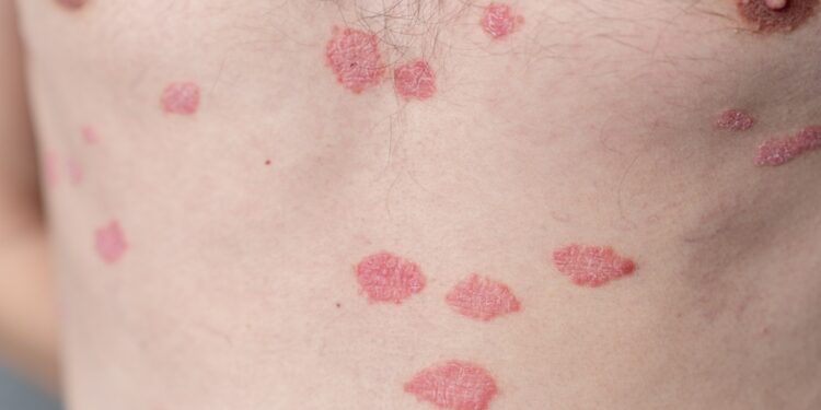 Lichen sclerosus: priežastys, simptomai, diagnostika ir gydymas