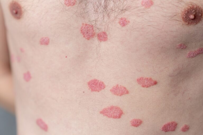 Lichen sclerosus: priežastys, simptomai, diagnostika ir gydymas