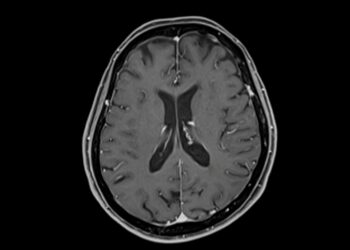 Aukštikalnėse pasireiškiantis smegenų pabrinkimas (HACE): simptomai ir gydymas