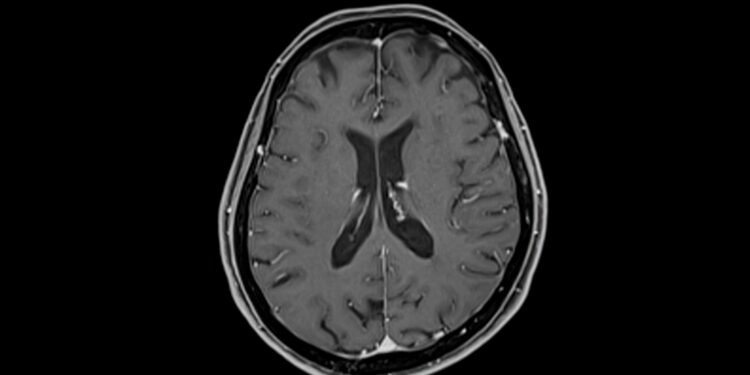 Aukštikalnėse pasireiškiantis smegenų pabrinkimas (HACE): simptomai ir gydymas
