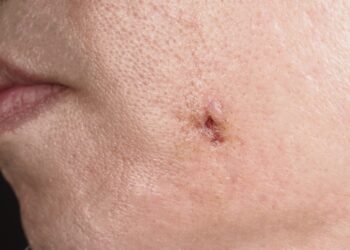 Ledo kirtiklio tipo galvos skausmas: kas tai, priežastys, simptomai ir gydymas