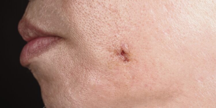 Ledo kirtiklio tipo galvos skausmas: kas tai, priežastys, simptomai ir gydymas