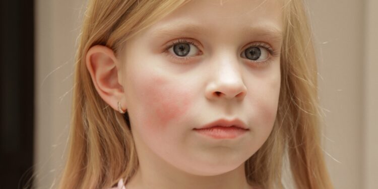 Vaikų lokalizuotos sklerodermijos simptomai ir priežastys