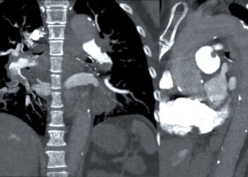 Dešinioji skilvelis