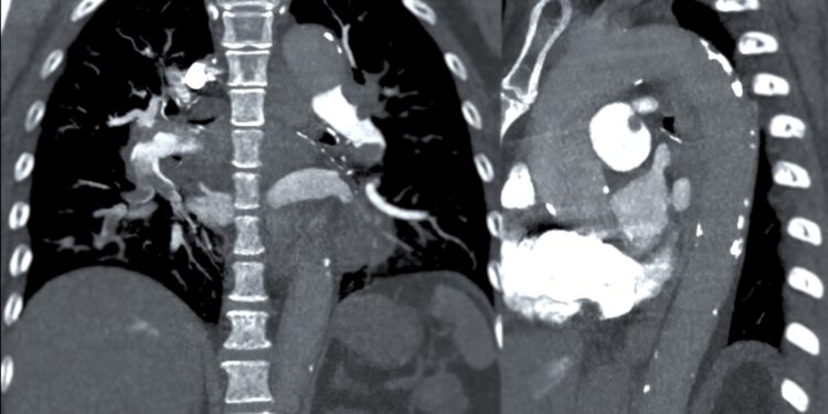 Dešinioji skilvelis