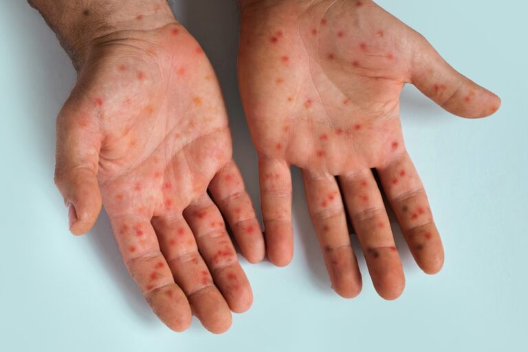 Tymų infekcija: bėrimas, priežastys, simptomai, gydymas ir prevencija
