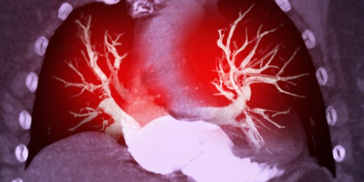 Hematotoraksas: priežastys, simptomai, diagnostika ir gydymas