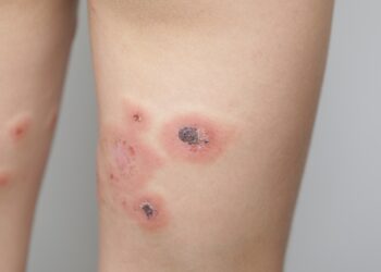 Impetigas: Užkrečiama odos infekcija – priežastys, gydymas ir prevencija