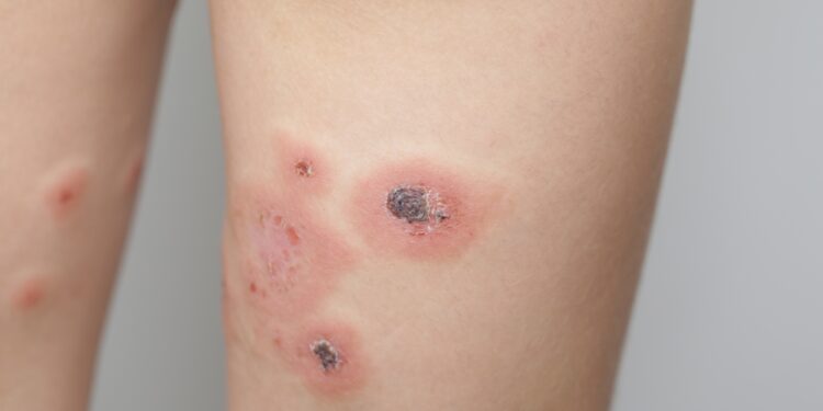 Impetigas: Užkrečiama odos infekcija – priežastys, gydymas ir prevencija