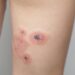 Impetigas: Užkrečiama odos infekcija – priežastys, gydymas ir prevencija