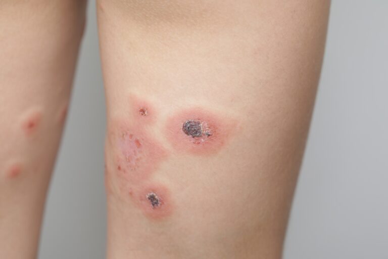 Impetigas: Užkrečiama odos infekcija – priežastys, gydymas ir prevencija