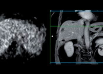 Kepenų vėžys: simptomai, požymiai, priežastys ir gydymas