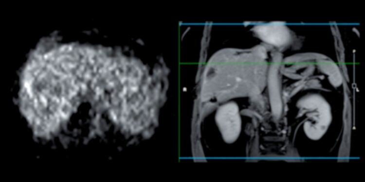 Kepenų vėžys: simptomai, požymiai, priežastys ir gydymas