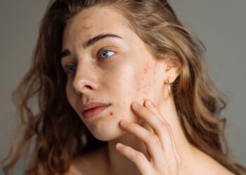 Užkrėstas spuogas: kaip atpažinti, priežastys ir gydymas