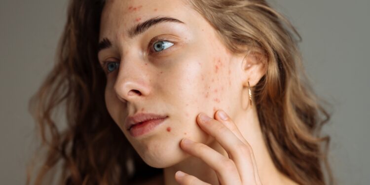 Užkrėstas spuogas: kaip atpažinti, priežastys ir gydymas