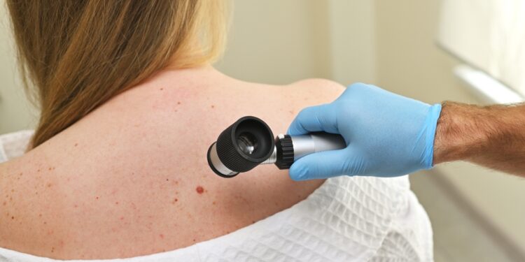 Melanoma: simptomai, stadijos ir gydymas