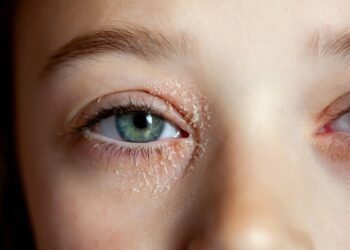 Vokų dermatitas: priežastys, simptomai, kontaktiniai veiksniai ir gydymas