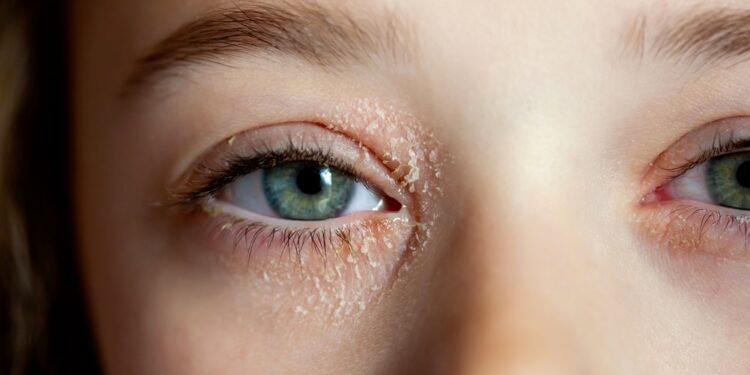 Vokų dermatitas: priežastys, simptomai, kontaktiniai veiksniai ir gydymas