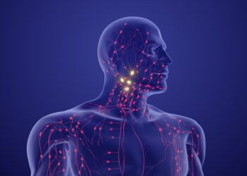 Hodžkino limfoma: simptomai, priežastys ir gydymas