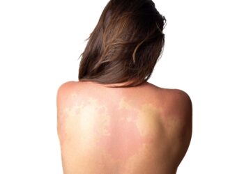 Alergija penicilinui: priežastys ir simptomai