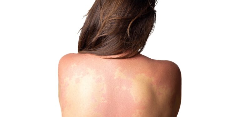 Alergija penicilinui: priežastys ir simptomai