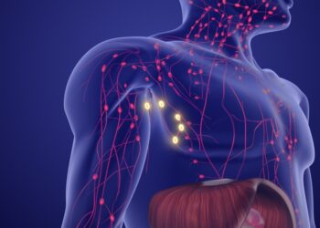 Limfoma: simptomai, priežastys ir gydymas