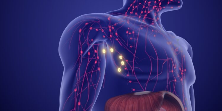Limfoma: simptomai, priežastys ir gydymas