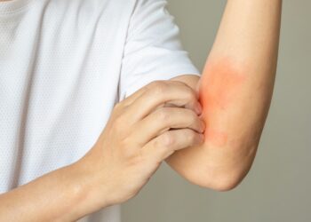 Tikslinės egzemos gydymo priemonės: Viskas, ką turite žinoti