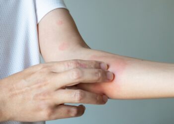 Geriausi patarimai iš žmonių, gyvenančių su psoriaze