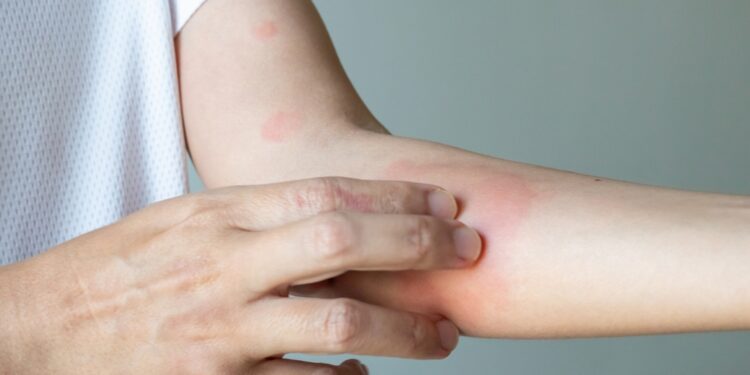 Geriausi patarimai iš žmonių, gyvenančių su psoriaze