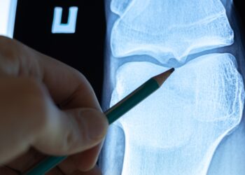 Osteoidinė osteoma: diagnostika, simptomai ir gydymas