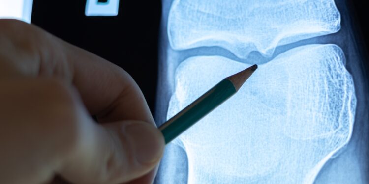 Osteoidinė osteoma: diagnostika, simptomai ir gydymas