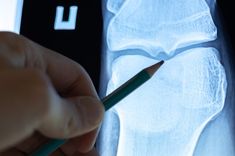 Osteoidinė osteoma: diagnostika, simptomai ir gydymas
