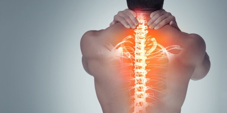 Idiopatinė skoliozė: kas tai, simptomai ir gydymas
