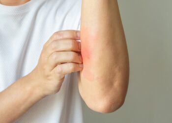 Užsikrėtusi egzema: kaip atpažinti, gydymas ir prevencija