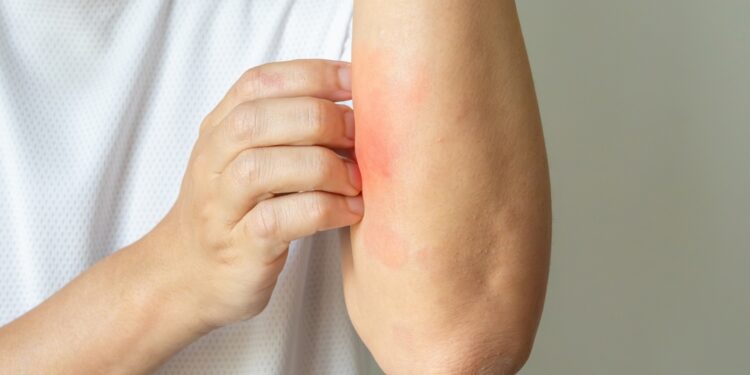Užsikrėtusi egzema: kaip atpažinti, gydymas ir prevencija