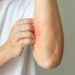 Užsikrėtusi egzema: kaip atpažinti, gydymas ir prevencija