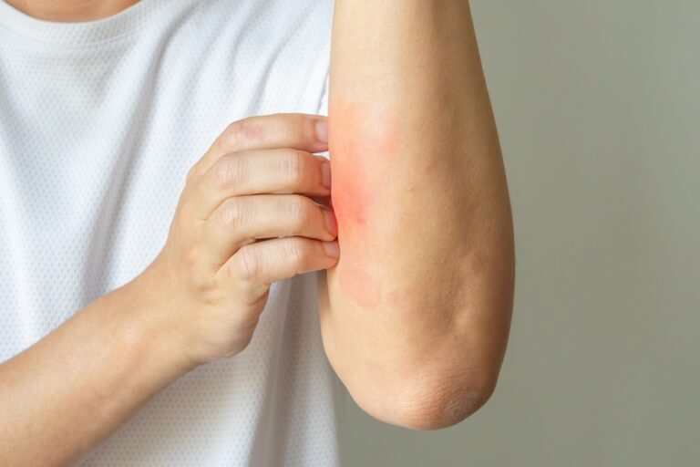 Užsikrėtusi egzema: kaip atpažinti, gydymas ir prevencija
