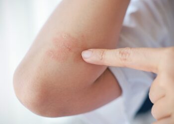 Eritroderminė žvynelinė: simptomai, priežastys ir gydymas