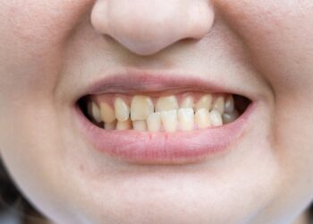 Netaisyklingas sąkandis (sukandimo anomalijos): tipai ir gydymas