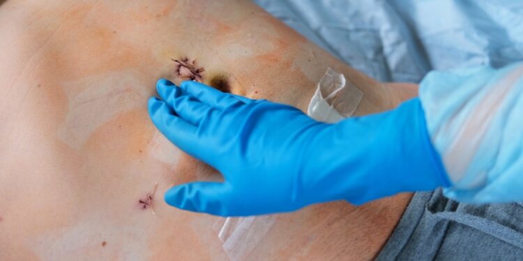 Bambos uždegimas (omfalitas): simptomai ir gydymas