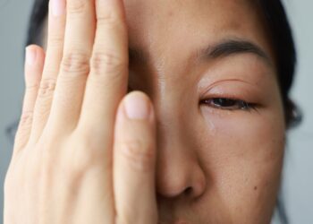 Akių lando uždegimas: priežastys, simptomai ir gydymas