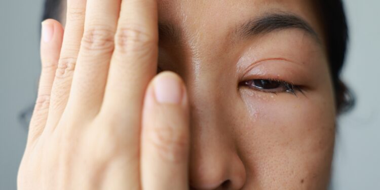 Akių lando uždegimas: priežastys, simptomai ir gydymas