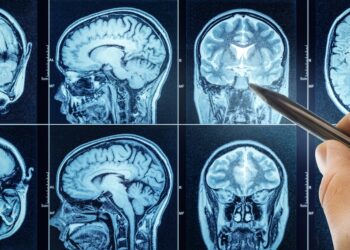 Pilocitinė astrocitoma: simptomai, gydymas ir prognozė