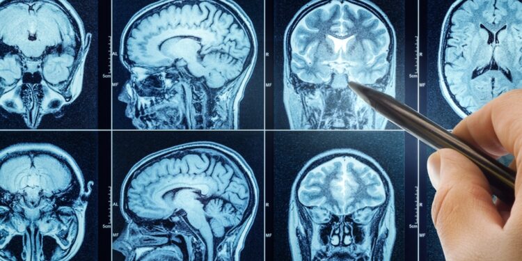 Pilocitinė astrocitoma: simptomai, gydymas ir prognozė