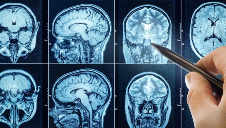 Pilocitinė astrocitoma: simptomai, gydymas ir prognozė