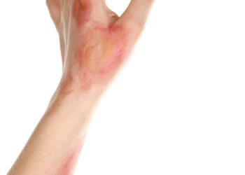 Žmogaus įkandimai: gydymas ir prognozė