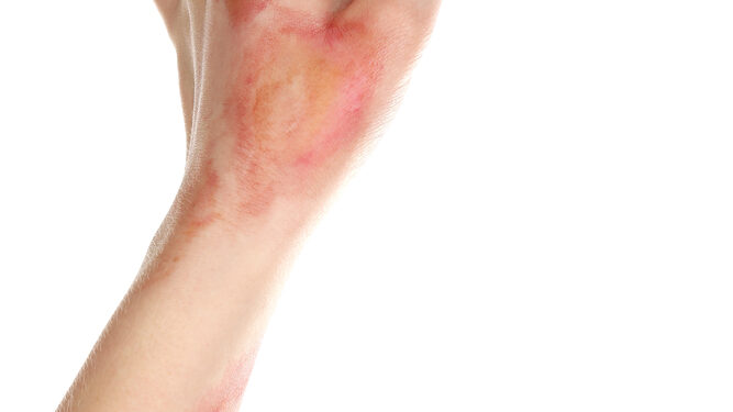 Žmogaus įkandimai: gydymas ir prognozė