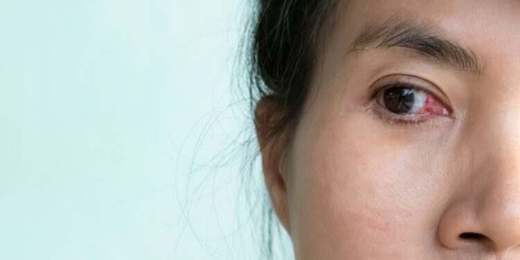 Pingvekula: kas tai, simptomai, priežastys ir gydymas